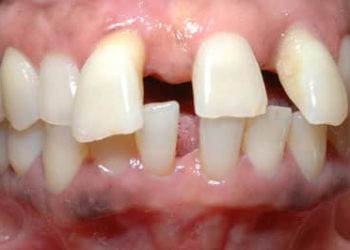 Gusamara kw’abavyeyi kuri mu bituma abana bakura bafise amenyo ahatanye